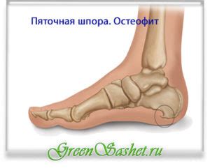Лечение и профилактика шпоры на мизинце: дополнительные советы