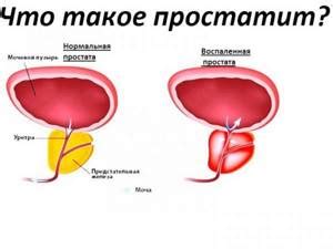 Особенности проведения массажа простаты