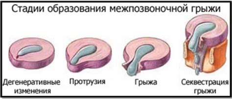 Причины возникновения грыжи
