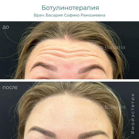 Результаты инъекции апофиса