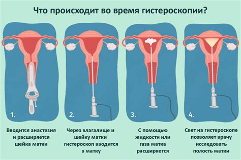 Что такое гистероскопия